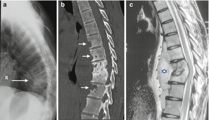 best-doctor-for-tuberculosis-tb-spine-in-ghatkopar